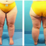 lipedema estagio dois, como tratar