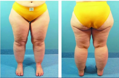 lipedema estagio dois, como tratar